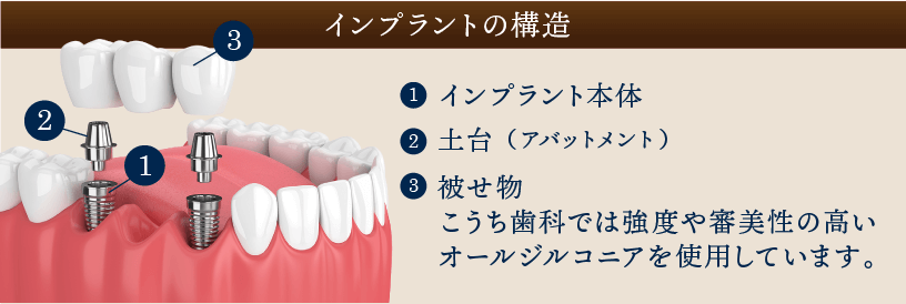 インプラントの構造 1.インプラント本体 2.土台（アバットメント） 3.被せ物 こうち歯科では強度や審美性の高いオールジルコニアを使用しています｡