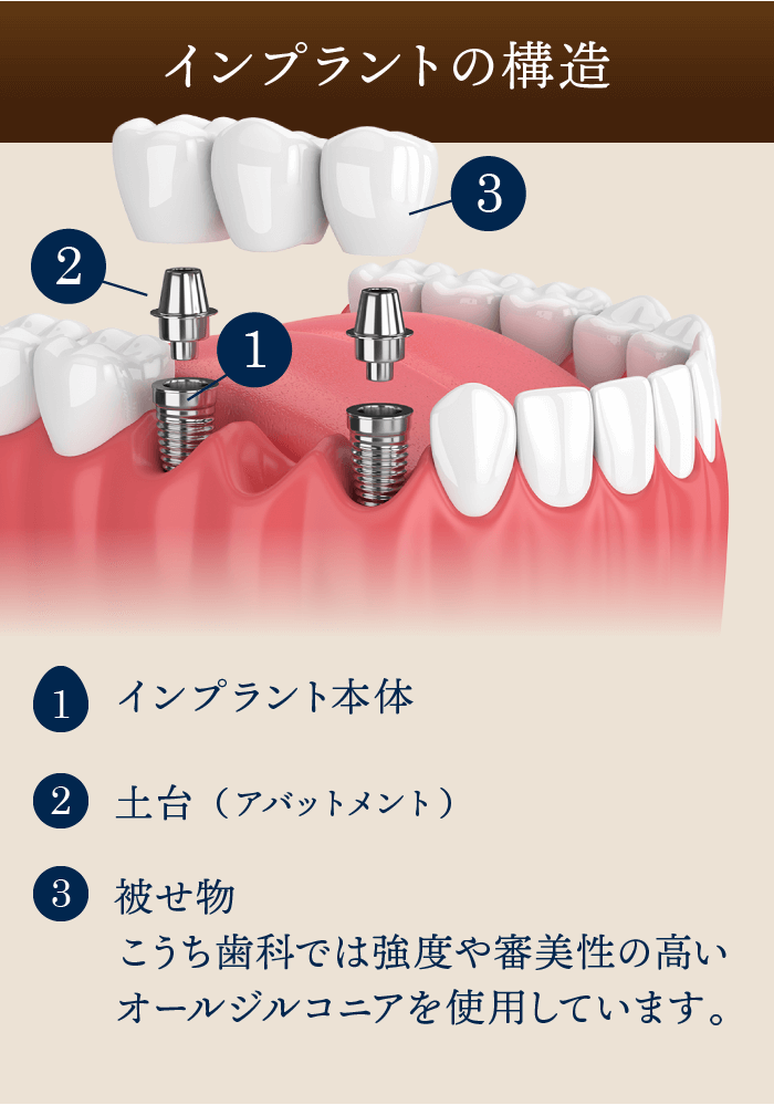 インプラントの構造 1.インプラント本体 2.土台（アバットメント） 3.被せ物 こうち歯科では強度や審美性の高いオールジルコニアを使用しています｡